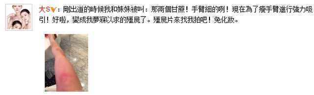 大S为减肥致手臂淤青 自嘲演僵尸片免化妆