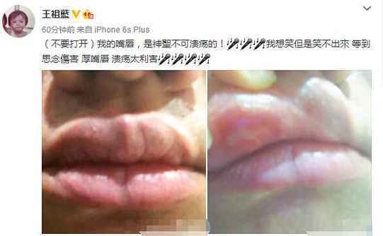吓人！王祖蓝晒溃疡嘴唇肿得像丰过唇