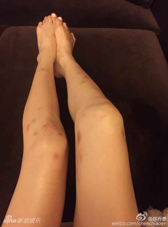 陈乔恩双臂双腿淤青 调侃自制淤青丝袜