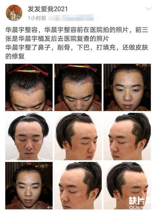 华晨宇出轨且整容是真的吗？华晨宇整容前照片曝光